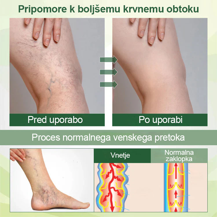 🌿Poslovite se od otečenih, bolečih nog – Mickey® FluidEase Profesionalna krema za izboljšanje prekrvavitve nog prinaša pravo olajšanje!