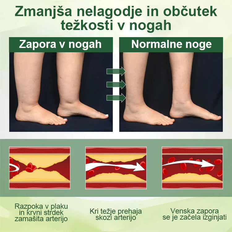 🌿Poslovite se od otečenih, bolečih nog – Mickey® FluidEase Profesionalna krema za izboljšanje prekrvavitve nog prinaša pravo olajšanje!