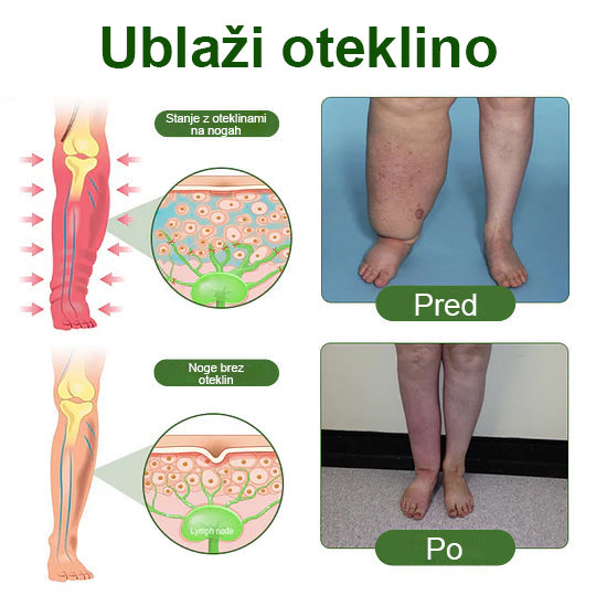 🌿Poslovite se od otečenih, bolečih nog – Mickey® FluidEase Profesionalna krema za izboljšanje prekrvavitve nog prinaša pravo olajšanje!